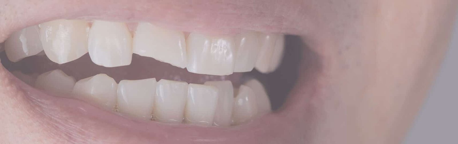 Como Arreglar un Diente Roto Sin Ir al Dentista