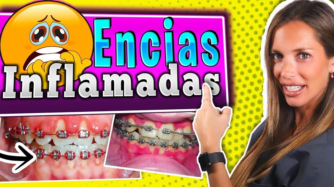 Como Desinflamar las Encías con Brackets Rápido