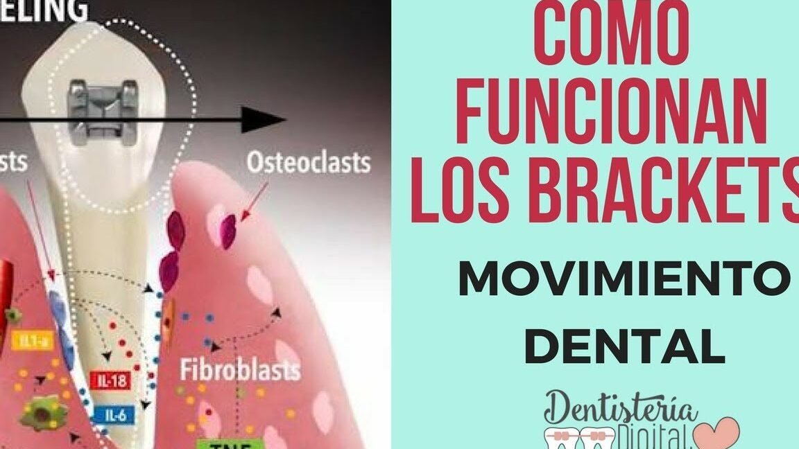 Como Funcionan los Brackets