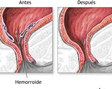 Como Queda El Ano Después De Una Operación De Hemorroides