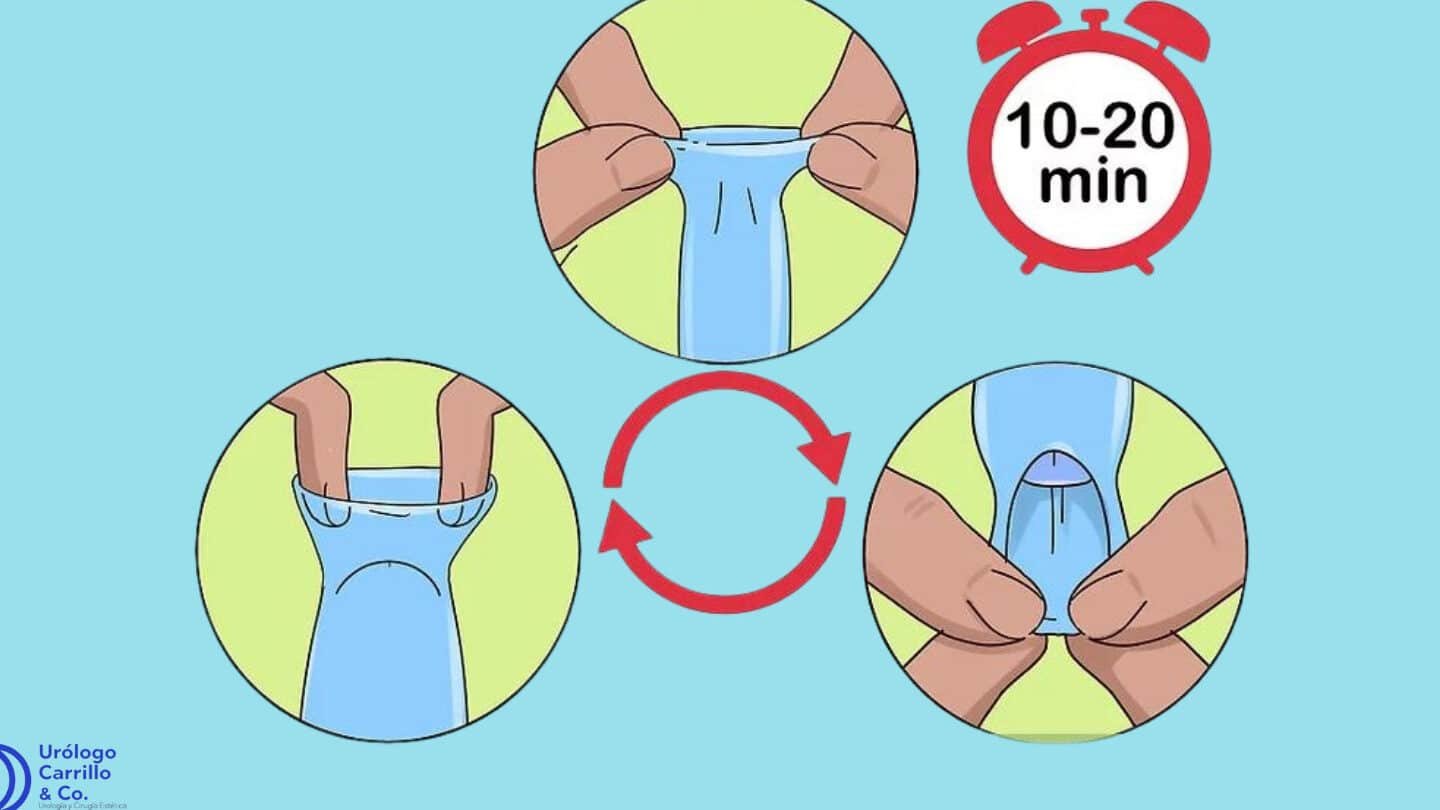 Cómo quitar el prepucio naturalmente