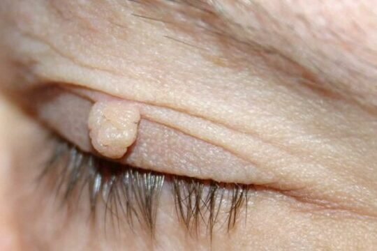 Como Quitar Verrugas de los Ojos