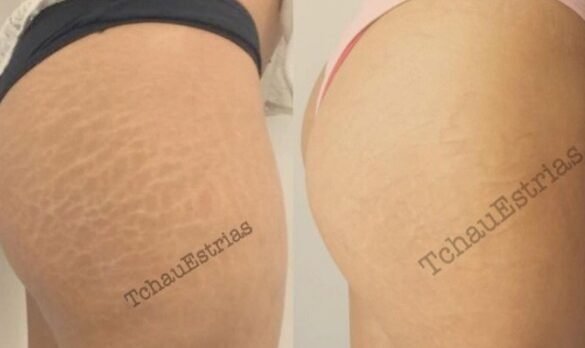 Como Tatuar Estrías