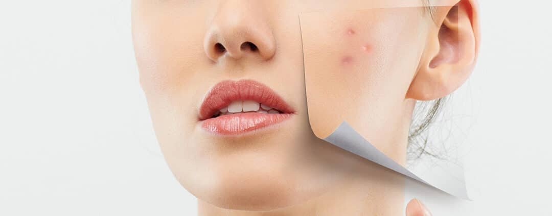 Como Tener la Cara Libre de Imperfecciones