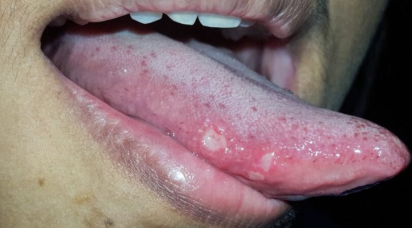 Por qué salen llagas en la lengua y cómo curarlas