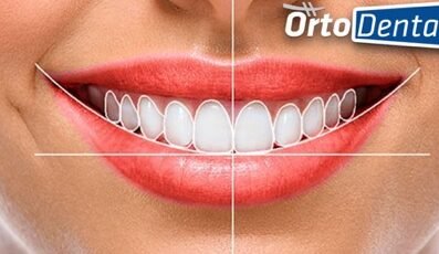 Sonrisas Perfectas: Descubre Cómo Sirven los Brackets y Mejora tu Sonrisa